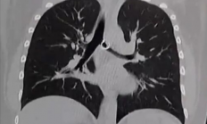 女子咳嗽一个月肺里惊现丢失鼻环 距离死亡仅剩0.5mm！