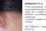 为什么没有人告诉我 打耳洞后会长这种肉疙瘩啊