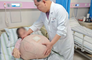 河北一女子肚子长80斤罕见巨瘤：血管暴突如蛛网 4小时切下