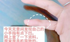 用小拇指做手机支架的受害者出现了：手指出现明显凹痕