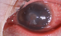 女子患流感5天不摘隐形眼镜近乎融化 医生：严重会造成永久性视力损伤