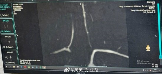 《英雄联盟》主播孙亚龙中风病情新动态：椎动脉血管闭塞严重 英雄联盟 孙亚龙 第2张