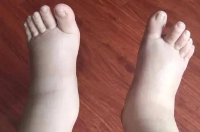 肝不好的人，如果每天吃一个鸡蛋，会发生什么？听听医生怎么说  肝不好的人 第2张