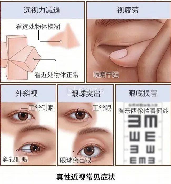 娃近视多少度需要戴眼镜？  娃近视多少度需要戴眼镜 第1张