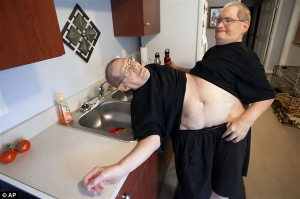 腹部相连只能轮流睡觉：世界最长寿男性连体双胞胎 68岁同时去世 世界最长寿男性连体双胞胎 第3张