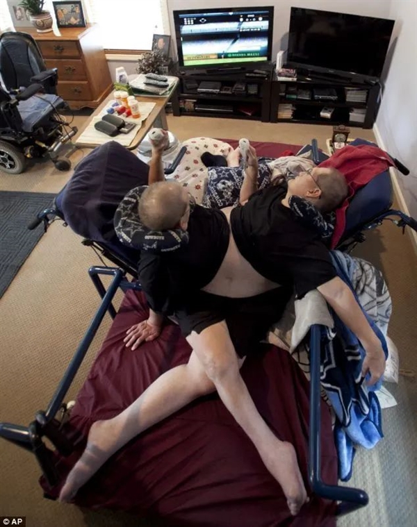 腹部相连只能轮流睡觉：世界最长寿男性连体双胞胎 68岁同时去世 世界最长寿男性连体双胞胎 第4张