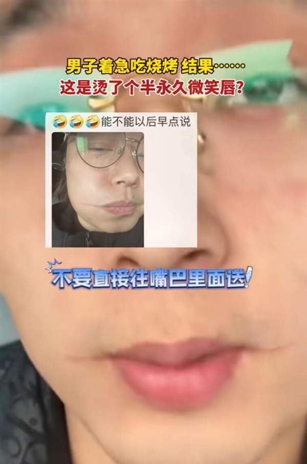 男子吃烧烤被烫出微笑唇：忽略了烤肉的铁签子温度高 男子吃烧烤被烫出微笑唇 第2张