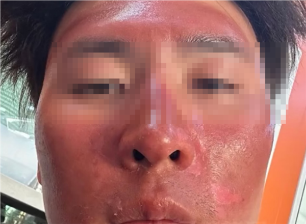 男子爬雪山晒伤成面膜脸：大面积流脓 脱皮 晒伤 第1张