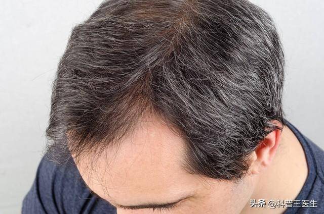 中年男性脱发与性功能减退，你忽视了这个危机吗？  中年男性脱发 性功能减退 第2张