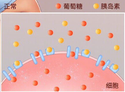 一少吃,就手抖?警惕胰岛素抵抗的微妙信号 胰岛素抵抗 第1张 一少吃,就手抖?警惕胰岛素抵抗的微妙信号 胰岛素抵抗 第1张