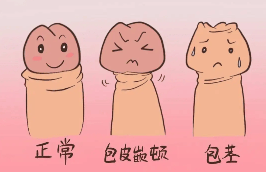 这四种情况需要做包皮手术，请对号入座  包皮手术 第1张