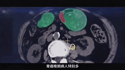 为了消灭癌症 他们把几千份遗憾喂给代码 癌症 第4张