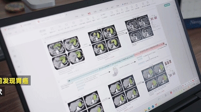 为了消灭癌症 他们把几千份遗憾喂给代码 癌症 第13张