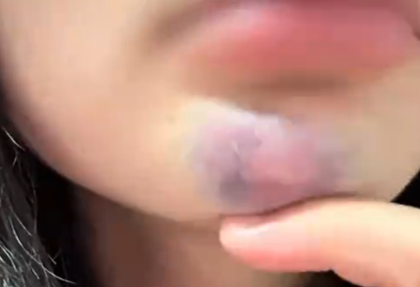 女子景区蹦极被推下受伤满脸是血 索赔得到一份免责协议 女子景区蹦极被推下受伤 第4张