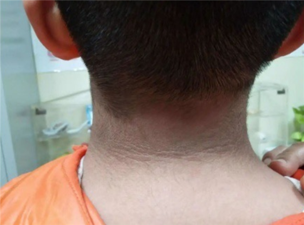 13岁男孩脖子洗不干净确诊黑棘皮病:胰岛素失控所致 黑棘皮病 第1张 13岁男孩脖子洗不干净确诊黑棘皮病:胰岛素失控所致 黑棘皮病 第1张