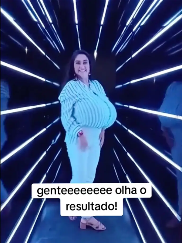 巴西女子患“巨乳症”失控!短短几月长O杯 出行得坐轮椅 巨乳症 第2张 巴西女子患“巨乳症”失控!短短几月长O杯 出行得坐轮椅 巨乳症 第2张