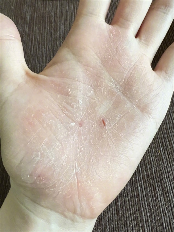 张靓颖自曝体检查出营养不良:额头血管莫名突起 伸懒腰手掌就流血 张靓颖 第2张 张靓颖自曝体检查出营养不良:额头血管莫名突起 伸懒腰手掌就流血 张靓颖 第2张
