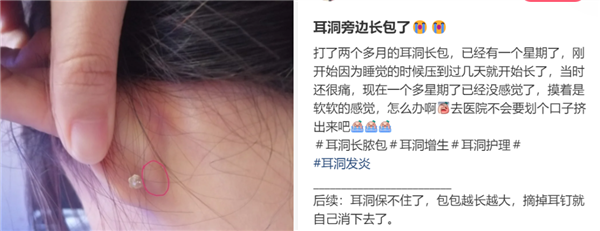 为什么没有人告诉我 打耳洞后会长这种肉疙瘩啊 打耳洞后会长这种肉疙瘩 第1张