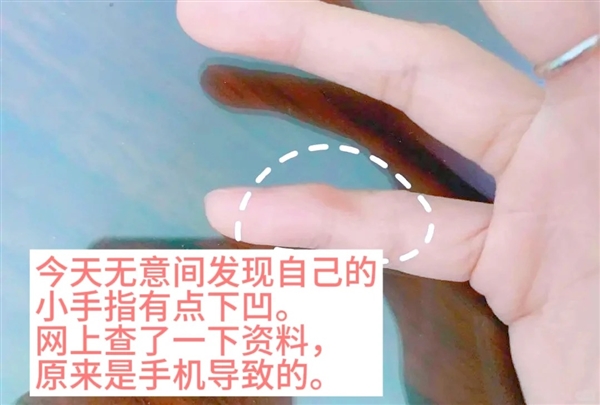 用小拇指做手机支架的受害者出现了:手指出现明显凹痕 用小拇指做手机支架 第1张 用小拇指做手机支架的受害者出现了:手指出现明显凹痕 用小拇指做手机支架 第1张